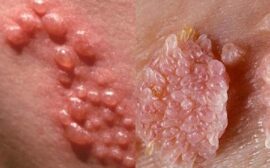 Sùi mào gà là bệnh lây truyền qua đường tình dục liên quan đến virus HPV, cần được hiểu đúng để phòng tránh an toàn. 