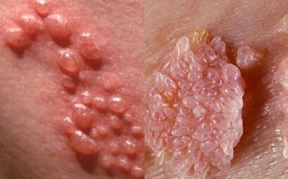 Sùi mào gà là bệnh lây truyền qua đường tình dục liên quan đến virus HPV, cần được hiểu đúng để phòng tránh an toàn. 