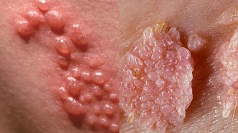Sùi mào gà là bệnh lây truyền qua đường tình dục liên quan đến virus HPV, cần được hiểu đúng để phòng tránh an toàn.