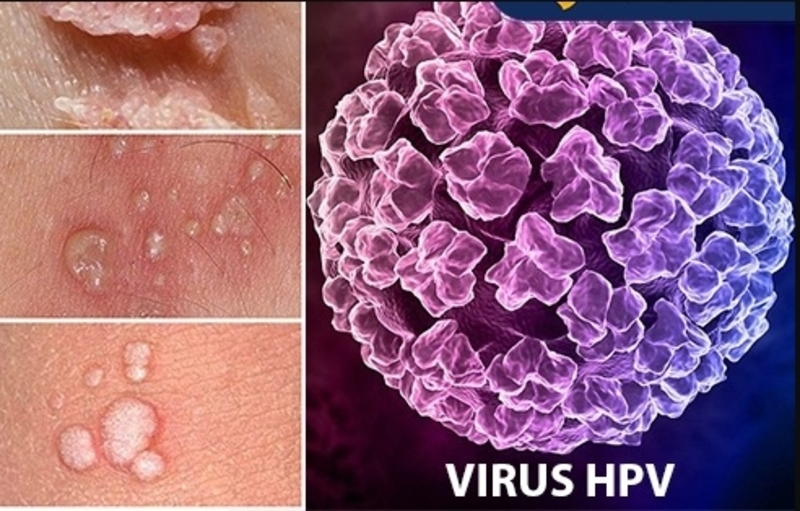 Virus HPV là nguyên nhân chính gây sùi mào gà, đặc biệt qua tiếp xúc tình dục không an toàn.
