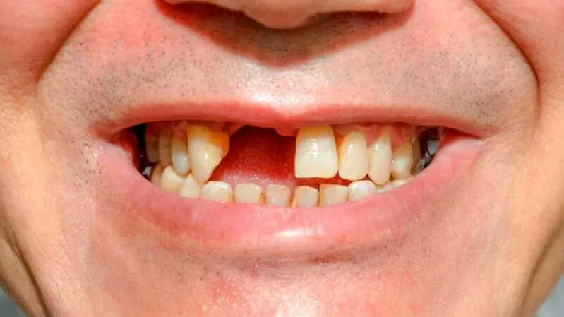 Theo dân gian, mơ rụng răng thường được liên hệ với sự thay đổi, mất mát hoặc lời nhắc về sức khỏe và quan hệ.