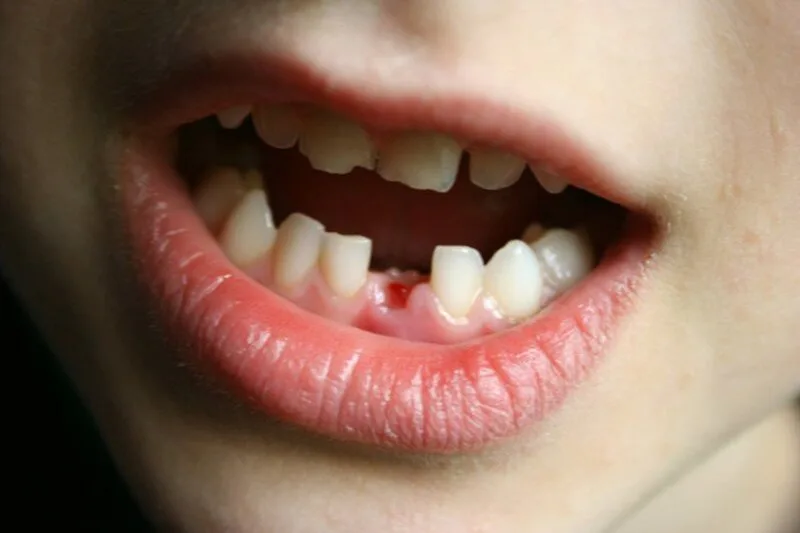 Mỗi chi tiết như đau, chảy máu, răng lung lay hay tự nhổ răng có thể gợi ra cách hiểu khác nhau.
